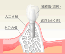 インプラントとは
