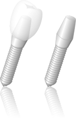 インプラント治療の流れ